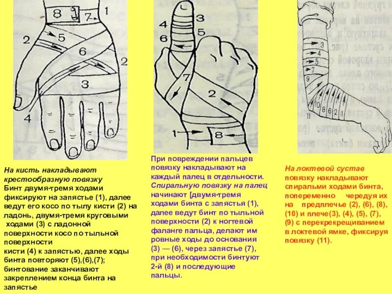 Рыцарская перчатка алгоритм. Наложение стерильной повязки на кисть. Крестообразная повязка на палец. Бинтовая повязка на кисть. Наложение бинтовой повязки на кисть.