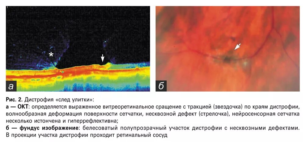 Периферические ретинальные дегенерации. Периферическая витреоретинальная дистрофия сетчатки. Периферическая витреоретинальная дегенерация сетчатки это. Оптическая когерентная томография при дистрофии сетчатки. Описание окт сетчатки.