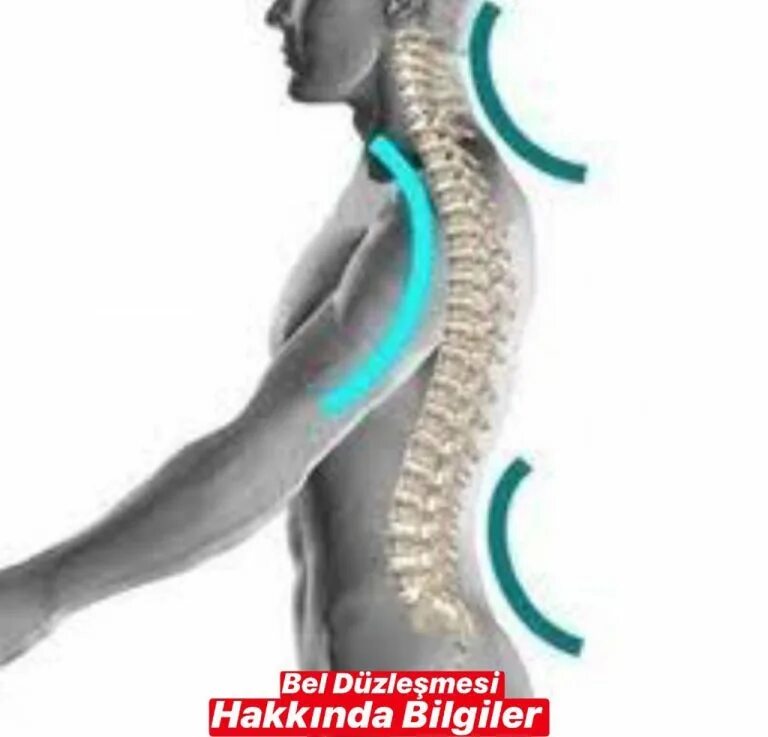 Усиленный лордоз. 1 лордоз. 1 лордоз. 1 лордоз. Лордоз.