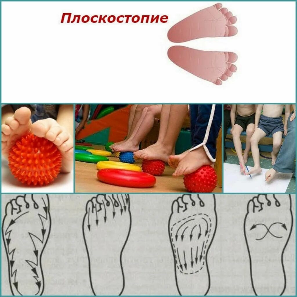 Упражнения при поперечном плоскостопии. Лечебная гимнастика для стоп при плоскостопии детям. плоскостопие гимнастика для ног для детей упражнения. лфк стопа плоскостопие. лечебная физкультура для стопы при плоскостопии.