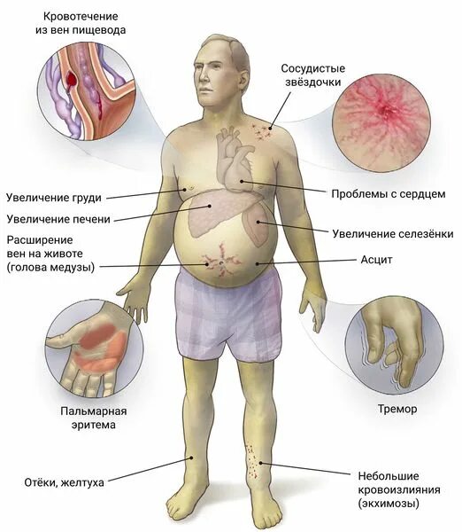 Алкогольный цирроз симптомы у мужчин. Алкогольный цирроз печени. Алкогольный цирроз симптомы. Характерные признаки алкогольного цирроза печени. Токсический алкогольный цирроз печени.