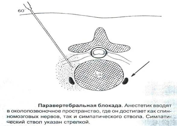 Паравертебральная поясничная блокада. Паравертебральная новокаиновая блокада техника. Шейная паравертебральная блокада методика. Паравертебральная блокада техника проведения.