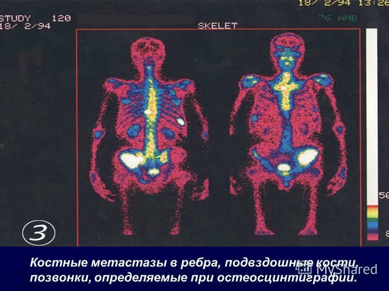 Метастазы в кости срок жизни