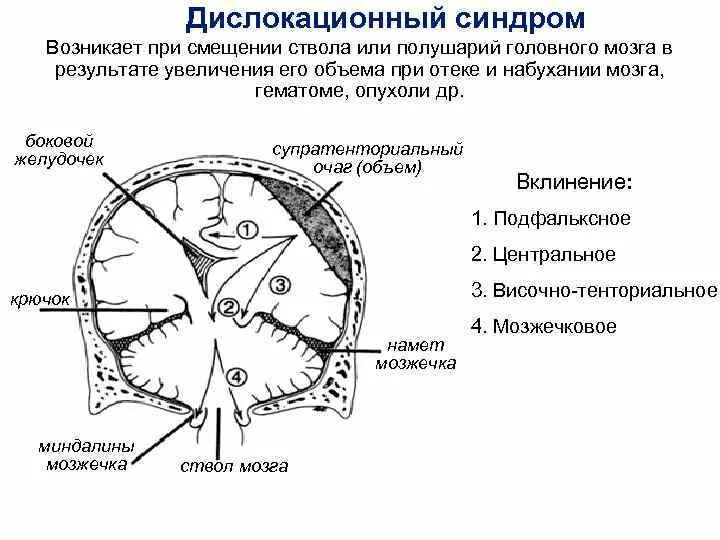 Вклинение ствола головного мозга. Дислокационные симптомы опухолей головного мозга. Симптомы вклинения мозжечка. Латеральное вклинение головного мозга.