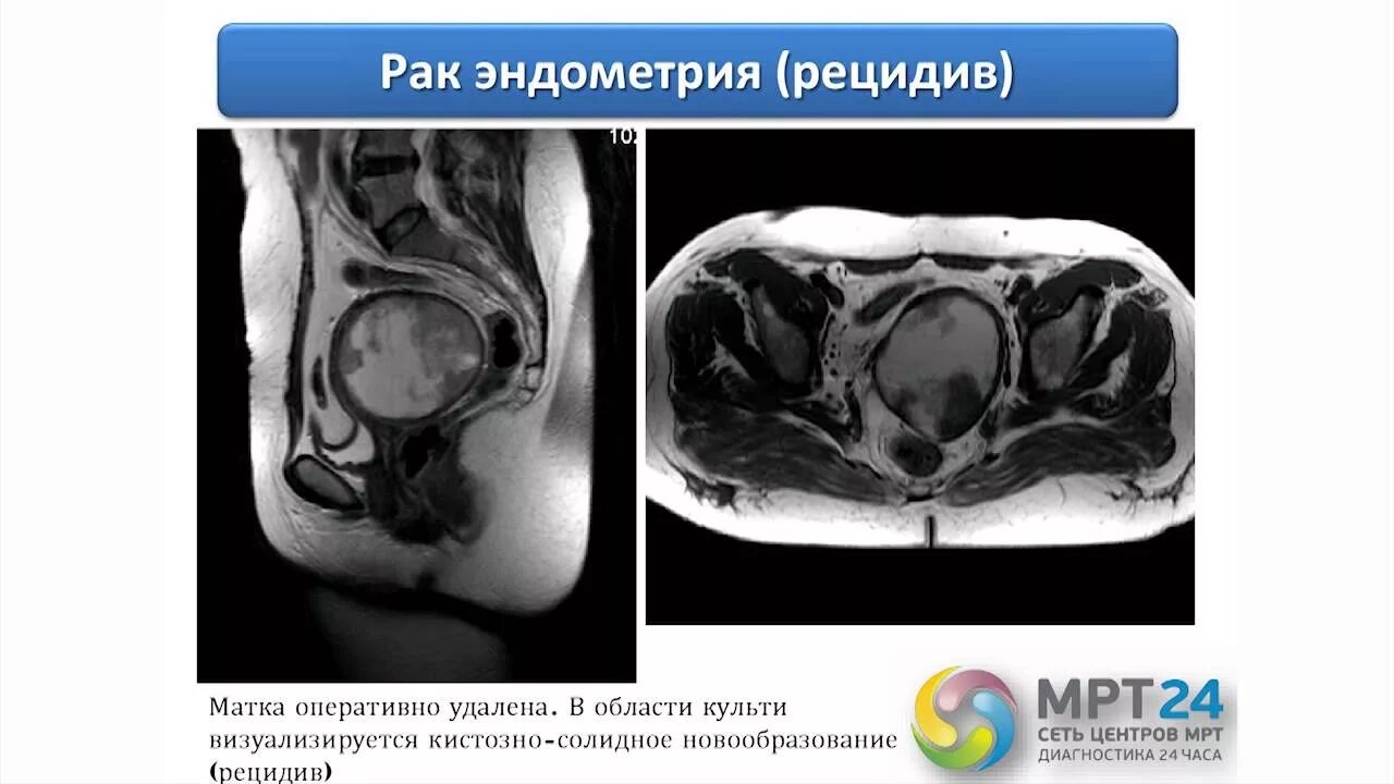 Толщина эндометрия мрт. Утолщение стенок матки кт. Артефакты на мрт малого таза. Мрт эндометрия