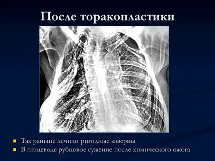 Торакопластика