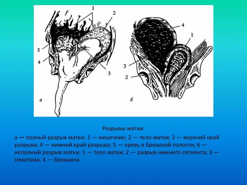 Разрывы отрыва. Механический разрыв матки. Самопроизвольный разрыв матки.