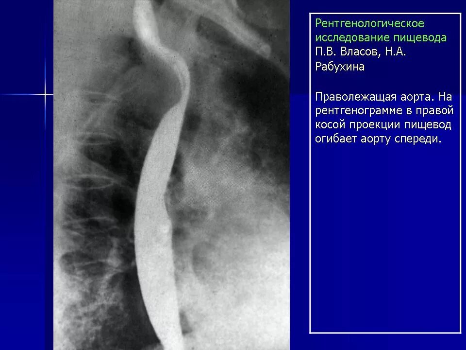 Дуги пищевода. Аневризма восходящей аорты рентген. Аневризма дуги аорты рентген. Правосторонняя аорта рентген. Аномалии пищевода рентген.