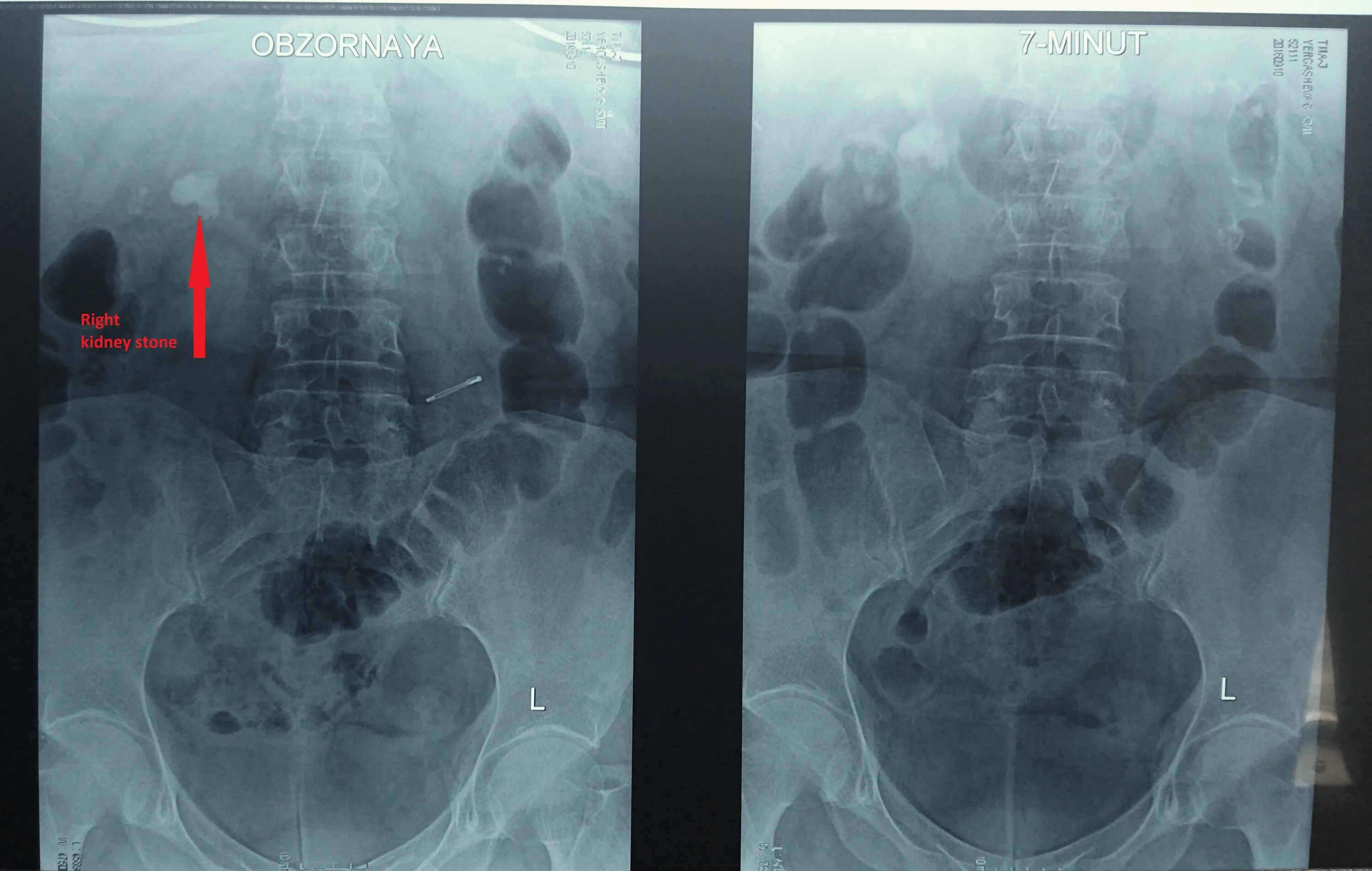 после дробления выходят камни. после дробления выходят камни. дробление камней в мочеточнике ультразвуком. дробление камней в мочеточнике ультразвуком. камень в почке 8мм на12мм.