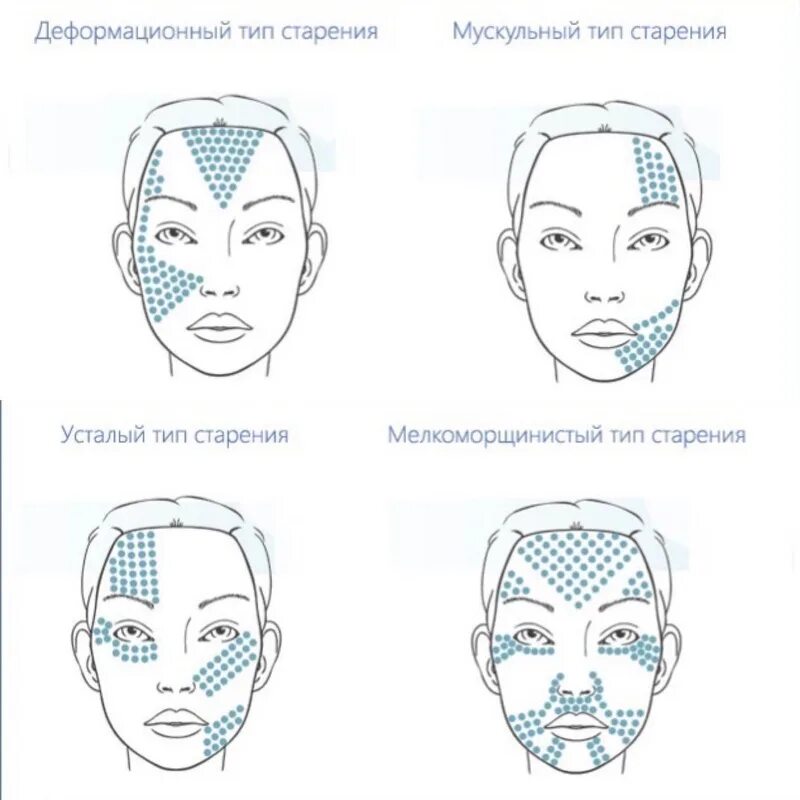 Подтяжка в схеме. Векторный лифтинг Радиесс схема введения. Схема мезотерапии ДМАЕ. Схема введения мезоботокса. Мезоксантин схема введения.