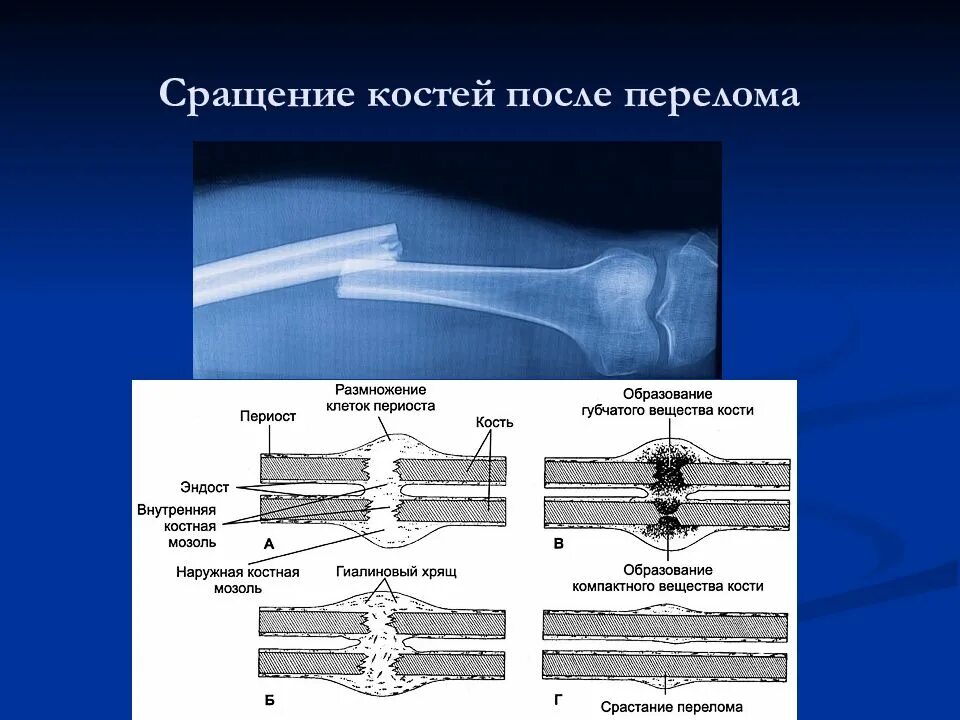 Сколько времени заживает кость. Этапы сращения перелома кости. Этапы срастания кости после перелома. Костные сращения костей. Сращение кости после перелома.