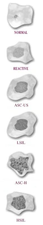 Asc h. Asc-us. asc-us, asc-h, lsil, hsil. asc forte.