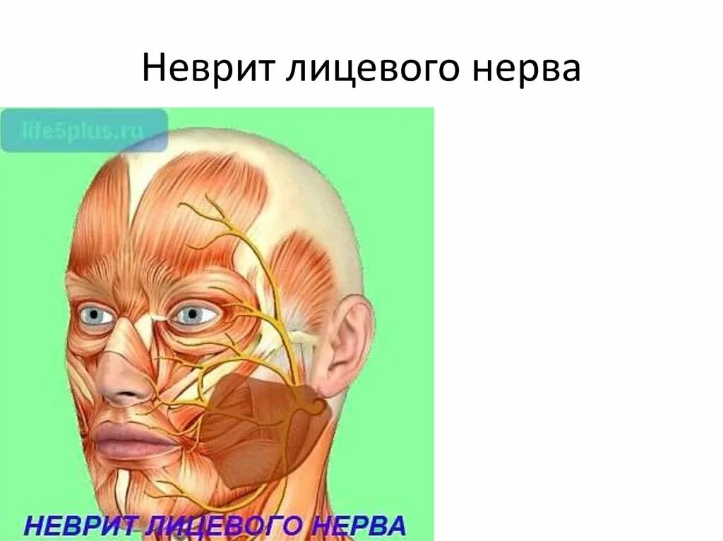 Правый лицевой нерв. Невропатия лицевого нерва. Лицевой неврит. Неврит лицевого лицевого нерва. Невропатия (неврит) лицевого нерва..