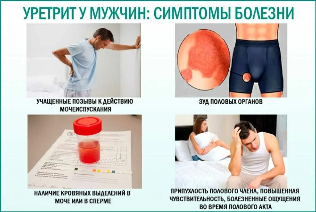 Частое мочеиспускание у мужчин. Уретрит у мужчин симптомы. Жжение после мочеиспускания у мужчин. Мочеиспускание. Мочеиспускание.