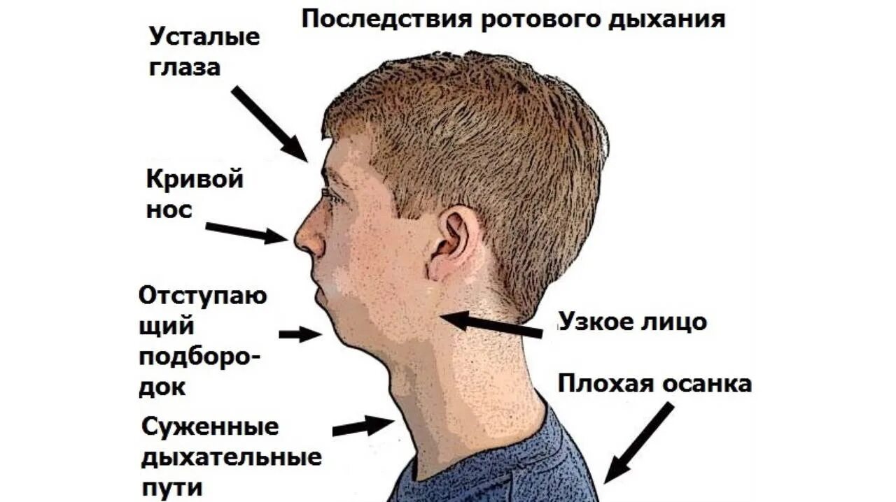 Дышу ртом форум. Дыхание носом. Лицо человека с аденоидами. Аденоидный Тип лица у детей.