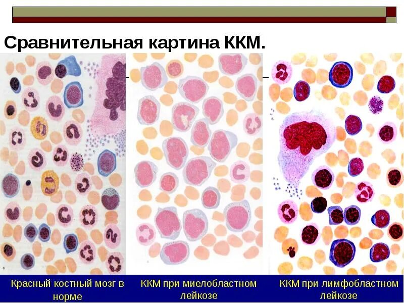 Результаты костного мозга. Мазок костного мозга в норме. Острый лимфобластный лейкоз костный мозг гистология. Острый лейкоз миелограмма. Красный костный мозг норма препарат.