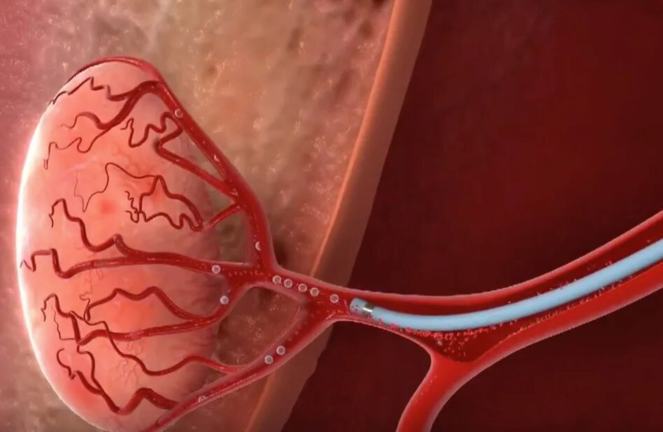 Артерии простаты. Эндоваскулярная эмболизация. Эндоваскулярная эмболизация простатических артерий. Эмболизация предстательной железы. Эмболизация артерий предстательной железы.