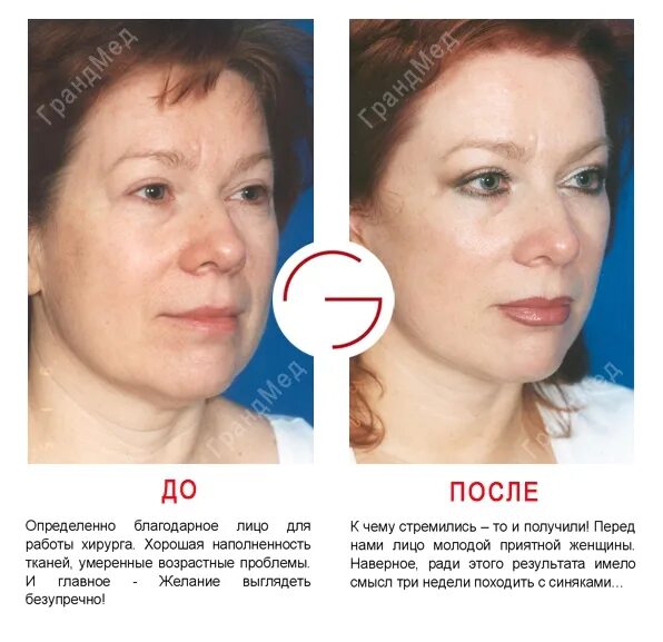 Микротоки лицо до и после фото отзывы. Фейсбилдинг для лица до и после. микротоки для лица результат. гимнастика для лица до и после. бодифлекс для лица.