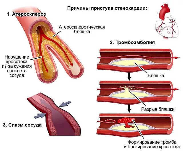 Разрыв бляшки. Атеросклероз венечных сосудов сердца симптомы. Симптомы атеросклероза коронарных артерий сердца. Спазм коронарных артерий причины. Факторы возникновения стенокардии.