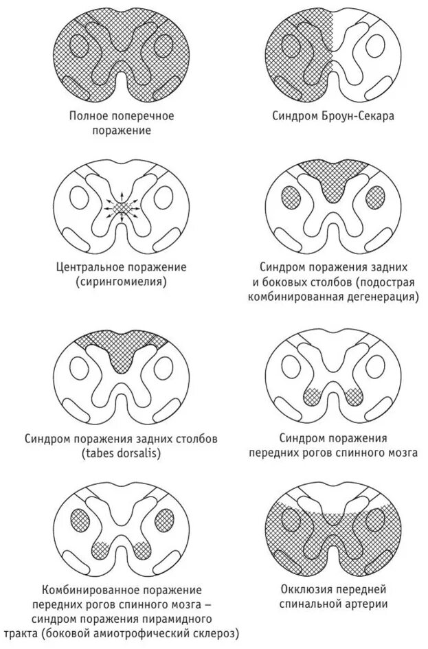 Поражение передних рогов. Синдром полного поражения спинного мозга. Синдром поражения поперечника спинного мозга. Поражение заднего рога спинного мозга неврология. Синдром поражения шейного отдела спинного мозга неврология.