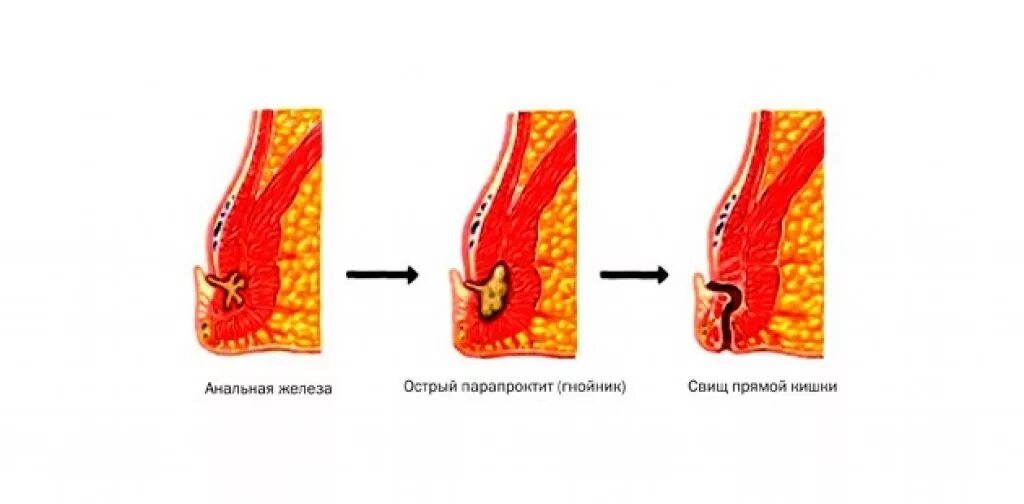 Снять спазм сфинктера при трещине. Подкожный парапроктит. Параректальный свищ симптомы.