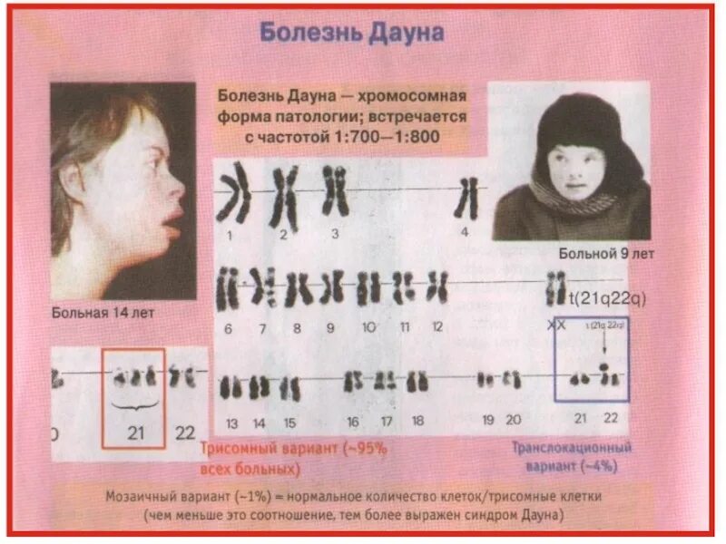 Как выявить синдром дауна. Транслокационная форма синдрома дауна. сертификат синдрома дауна.