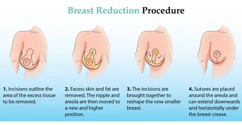 Geçen yıllar içerisinde meme küçültme ameliyatlarında memenin şeklinin cild...