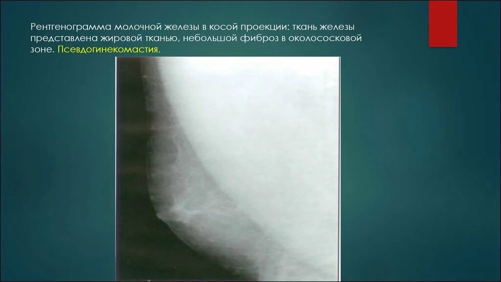Фиброаденома молочной железы рентгенограмма. Фиброзная мастопатия молочных желез рентген. Диффузная фиброзно-кистозная мастопатия рентген. Фиброзно-железистая ткань молочной железы.