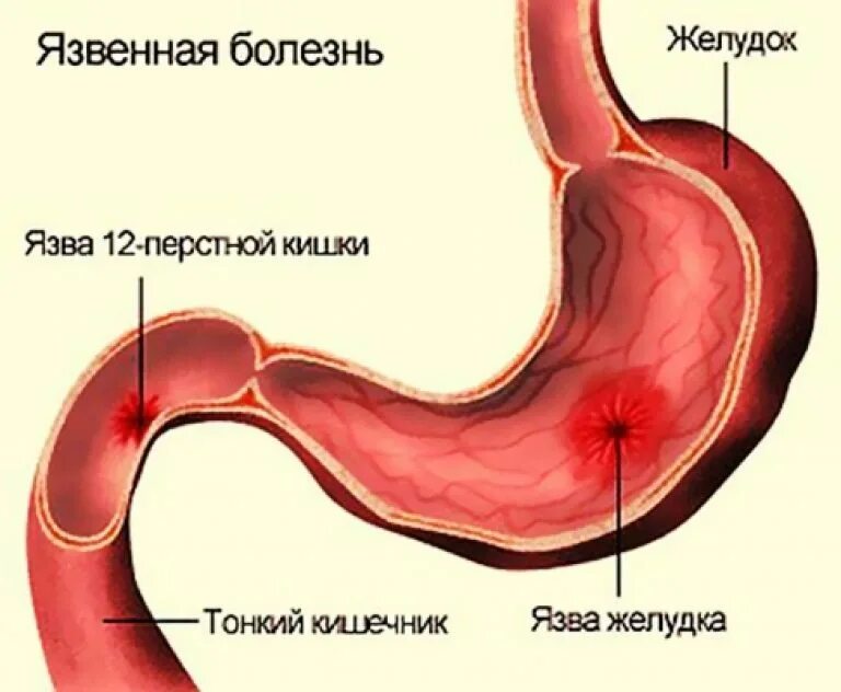 Желудок человека сообщение. Язва желудка и 12 перстной кишки. Презентация о желудке человека. Желудок человека сообщение. Почему маленький желудок.