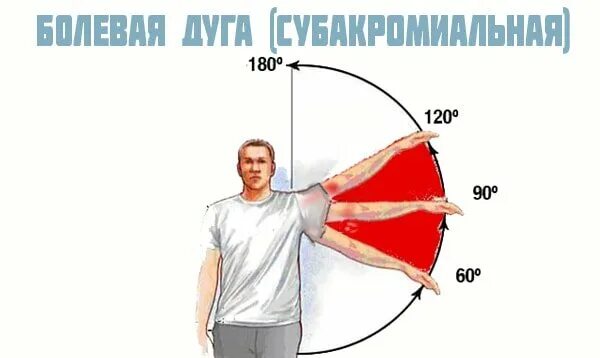 Боль в руке при поднятии и отведении. Плечевой сустав болит при поднятии руки. Болезненная дуга плечевой сустав. Боль в плече при поднятии руки вверх. Боль при подъеме руки вверх в плече.