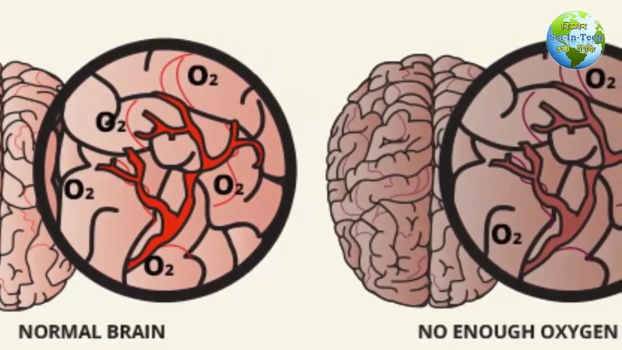 Кислород не поступает в мозг. Кислородное голодание головного мозга. Снабжение мозга кислородом.