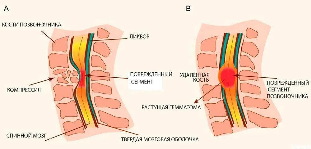 Компрессия шейного отдела позвонка. Защемление корешка спинного мозга. Сдавление Корешков спинного мозга симптомы. Механическое повреждение спинного мозга. Лечение защемления нерва в грудном отделе позвоночника