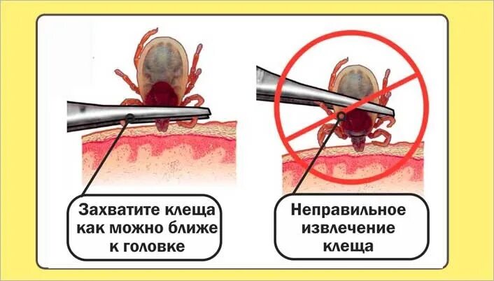 Осторожно клещи памятка для детей. Если клеща потеряли что делать. Как понять что правильно вытащили клеща. Если осталась головка клеща. Алгоритм действий при укусе клеща в поликлинике.