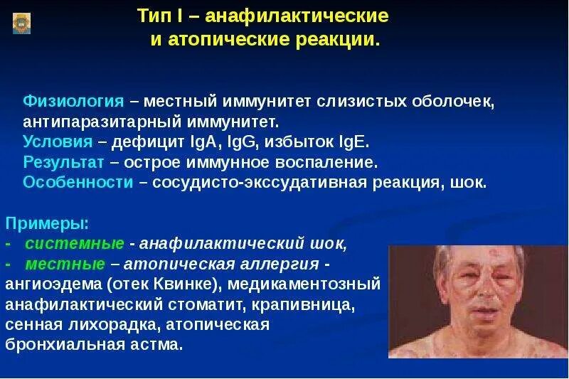 Анафилактический тип реакции. Анафилактический ШОК отек. Анафилактический ШОК это аллергическая реакция. Анафилактический ШОК крапивница. Анафилактическая аллергическая реакция.