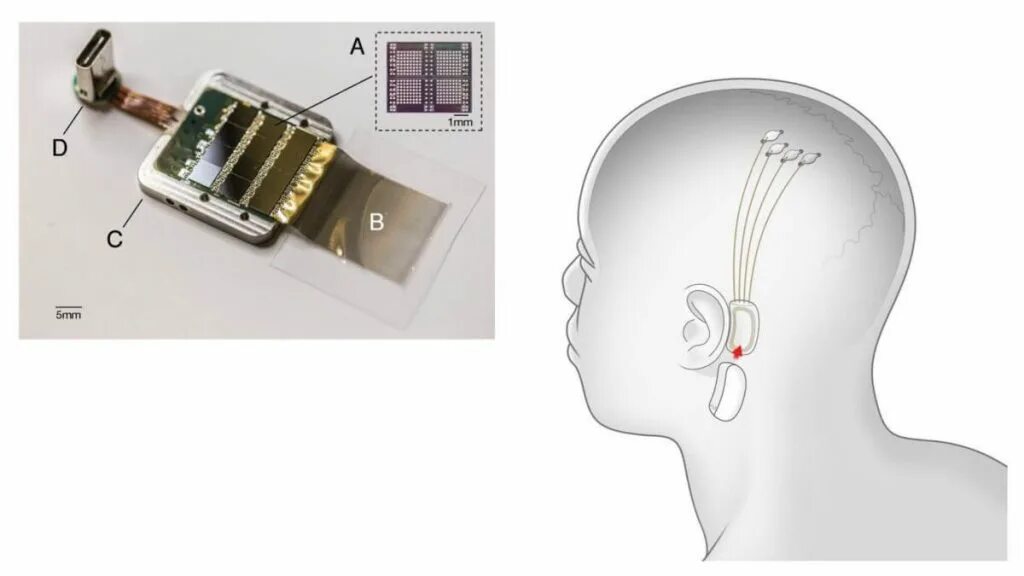 Маск вживил чип в мозг. Чип Neuralink n1. Нейроинтерфейс Нейролинк.