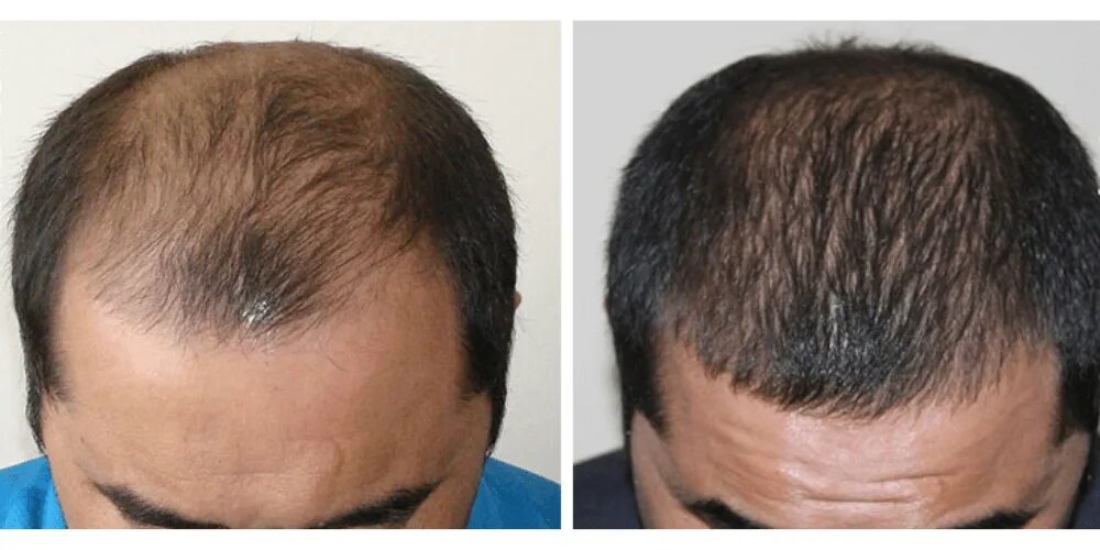 Волосы до после мужчины. Волосы после пересадки волос. Стрижка после пересадки волос. Трансплантация волос до и после.