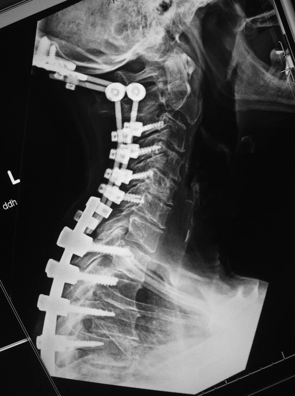 Фиксаторы позвоночника Stryker Spine. Транспедикулярная фиксация позвоночника. Кейдж межпозвонковый. Фиксация позвоночника металлоконструкциями. Операция фиксация позвоночника