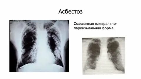 Асбестоз