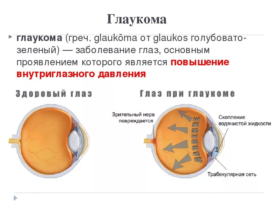 Заболевание глаз глаукома. Глаукома схема глаза.
