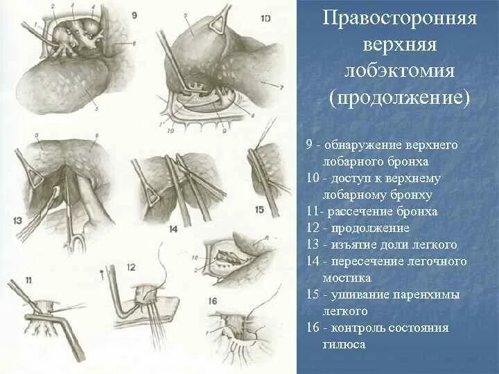Лобэктомия верхней доли легкого. Верхняя лобэктомия легкого. Средняя лобэктомия правого легкого. Лобэктомия нижней доли правого лёгкого. Лобэктомия верхней доли правого легкого.