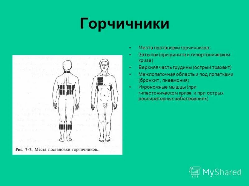 Можно ли ставить горчичники при кашле взрослому. Схема постановки горчичников при пневмонии. Схема наложения горчичников при кашле. Схема постановки горчичников при трахеите. Схема постановки горчичников при бронхите.