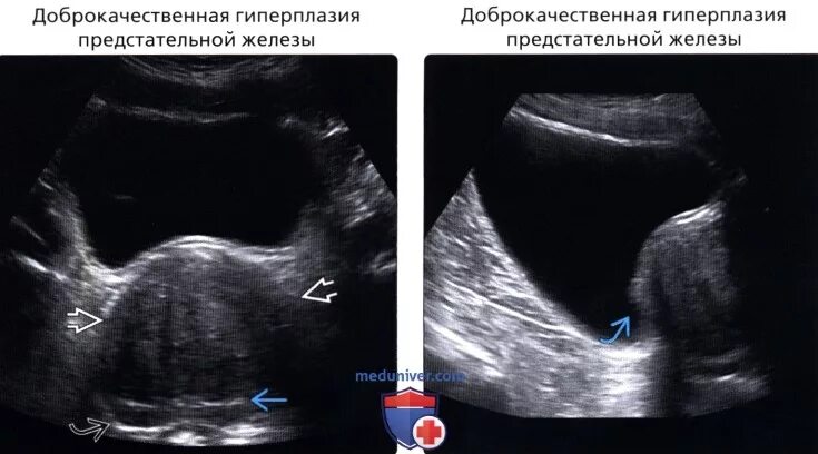 Дгпж узи. Трансабдоминальное УЗИ предстательной железы. УЗИ простаты трансабдоминально. УЗИ простаты и мочевого пузыря трансабдоминально. Аденома УЗИ трансабдоминальное.