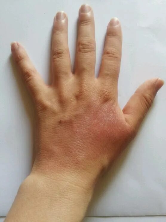 Burn my hand перевод. Sign you might Burn your hands. Burned hand