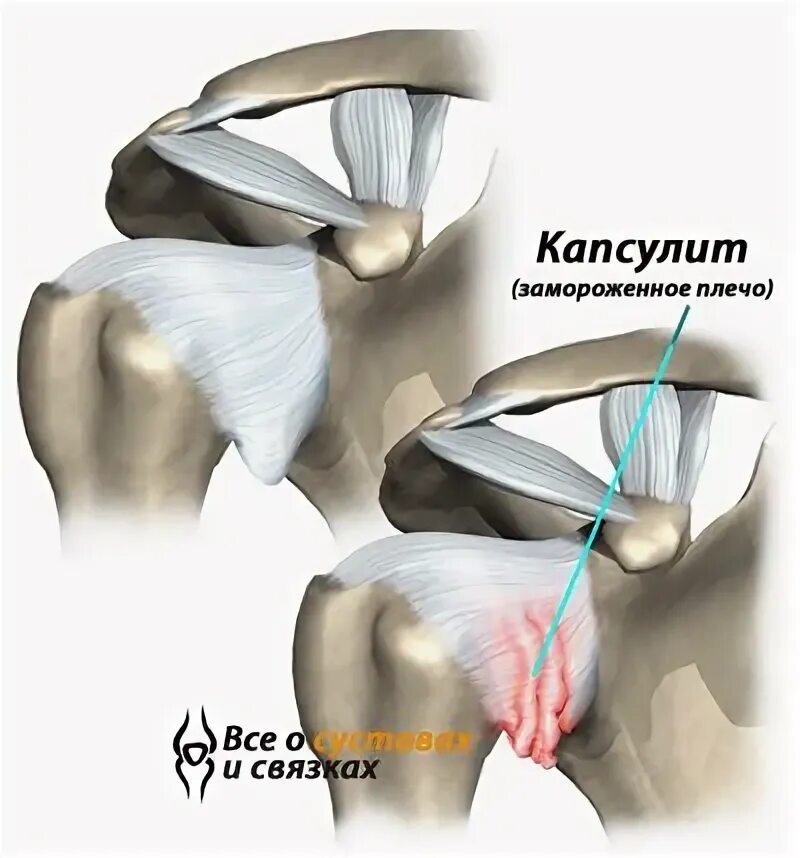 Адгезивный капсулит плечевого сустава симптомы. Ретрактильный капсулит плечевого сустава. Воспаление суставной капсулы плечевого сустава.