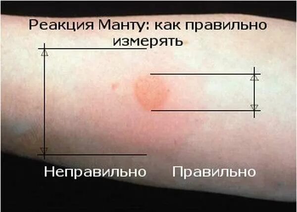 Диаскинтест взрослых где сделать