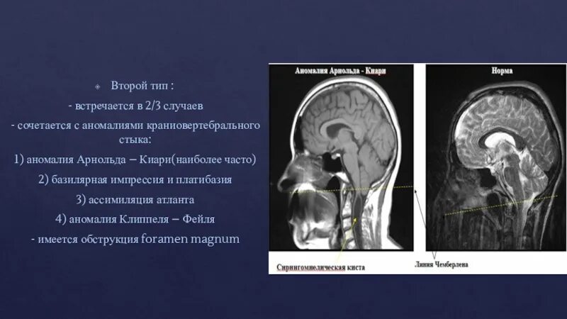 Аномалия 2 степени. Аномалия Арнольда-Киари 2 типа кт. Аномалия Арнольда Киари клиника. Аномалия Арнольда-Киари 1 типа мрт. Аномалия Арнольда-Киари 1-2 Тип.