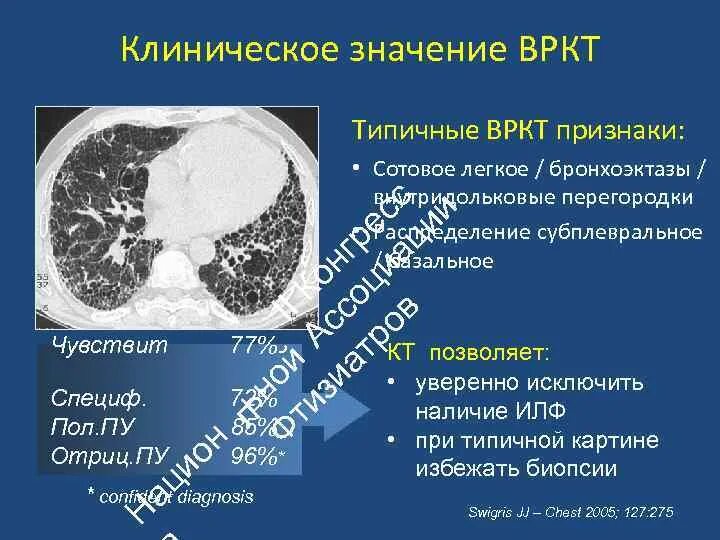 Субплевральные отделы легких. ВРКТ. Идиопатический легочный фиброз кт. ВРКТ это в медицине.