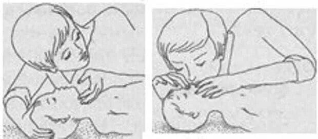 Инородные тела верхних дыхательных путей. Инородное тело в дыхательных путях у ребенка. Инородные тела верхних дыхательных путей у детей. Инородное тело в дыхательных путях рисунок.