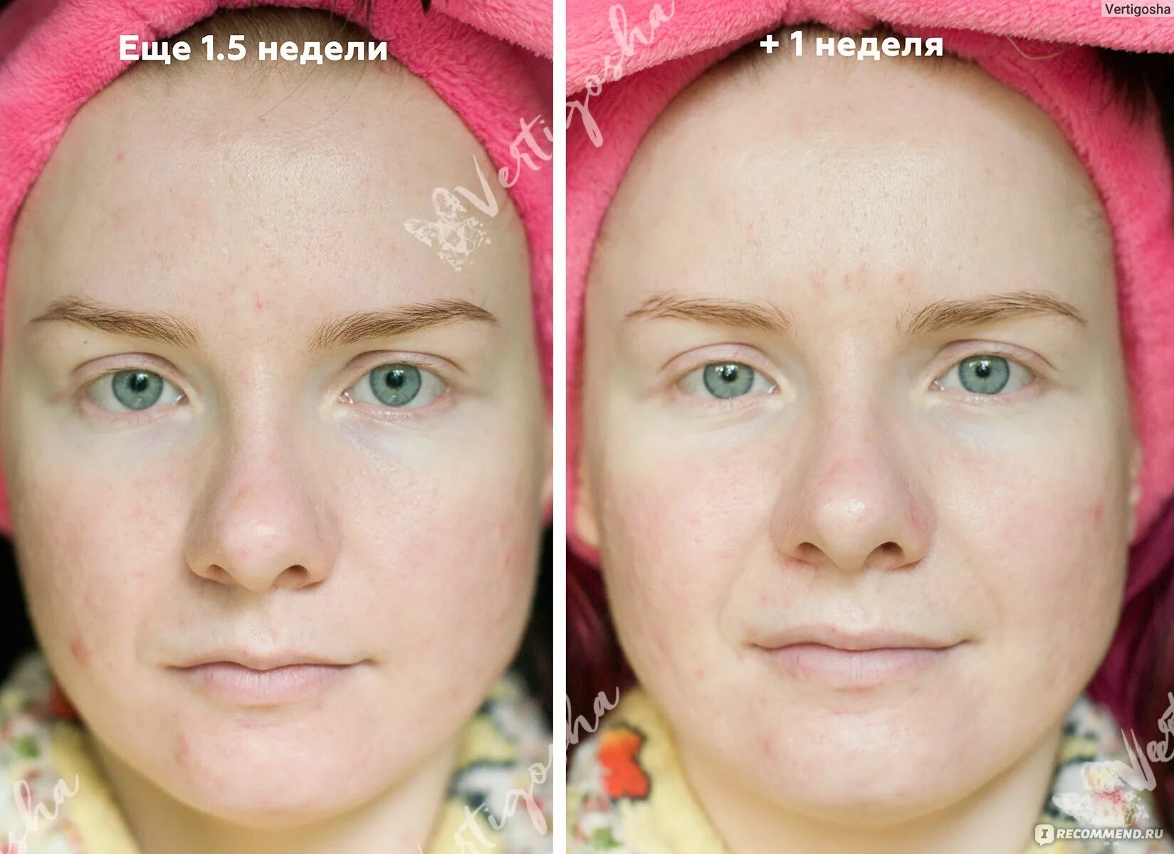 Микротоки лицо до и после фото отзывы. Микротоки для лица до и после. foreo микротоки. микротоки форео до и после. foreo bear до после.