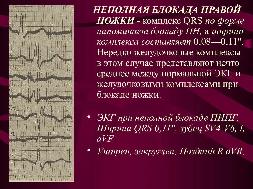 Блокада правой н п Гиса ЭКГ. Неполная блокада правой ножки на ЭКГ. QRS блокада правой ножки пучка Гиса. Неполная блокада правой ножки пучка Гиса. Частичная блокада ножки пучка гиса